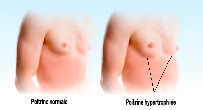 gynecomastie tunisie