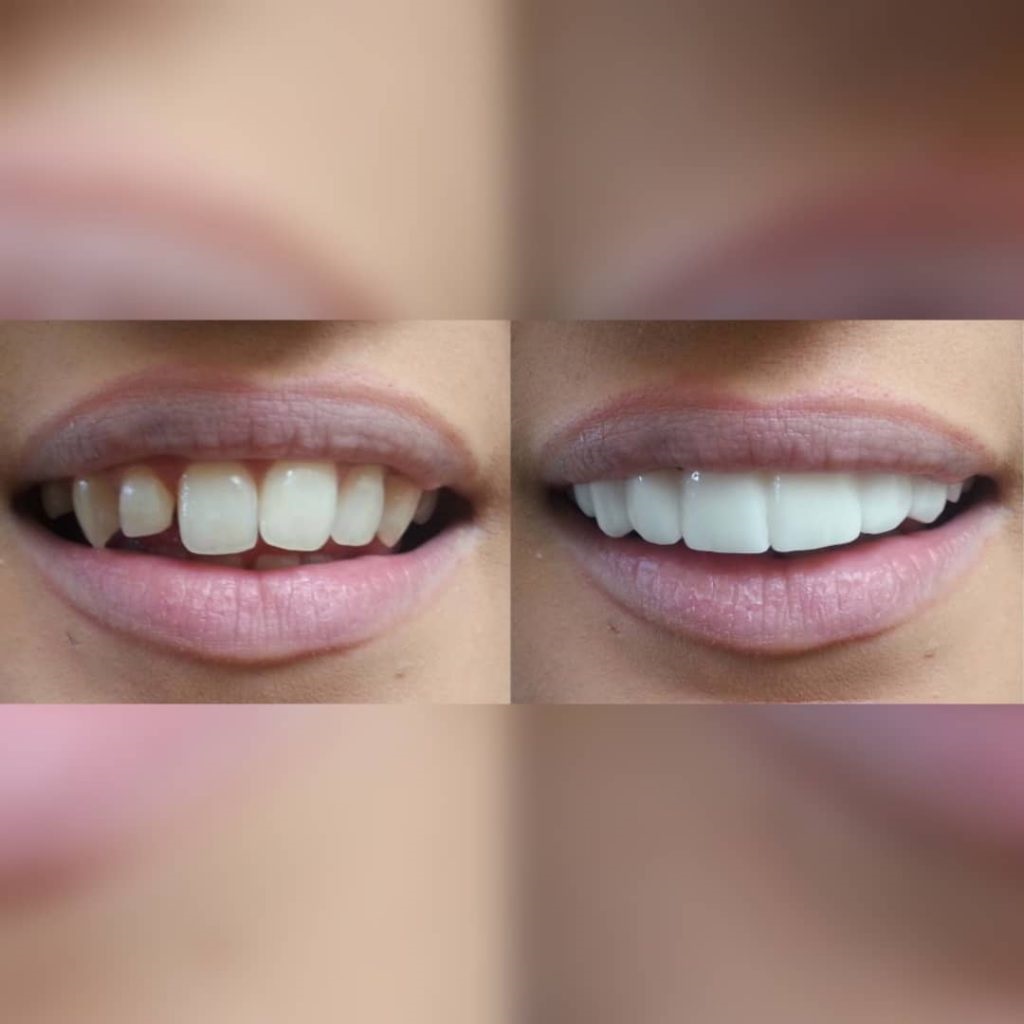 Vorher-Nachher: Zähne nach dem Anbringen der Veneers