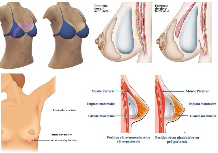 Brustprothese Tunesien