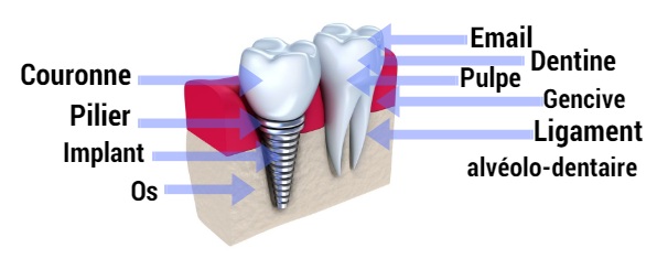 pose implant dentaire tunisie