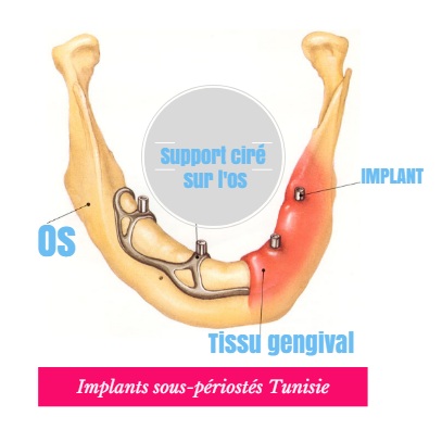 implant dentaire periostes Tunisie