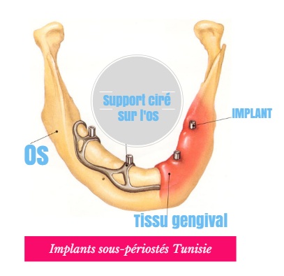 Zahnimplantat Periost Tunesien