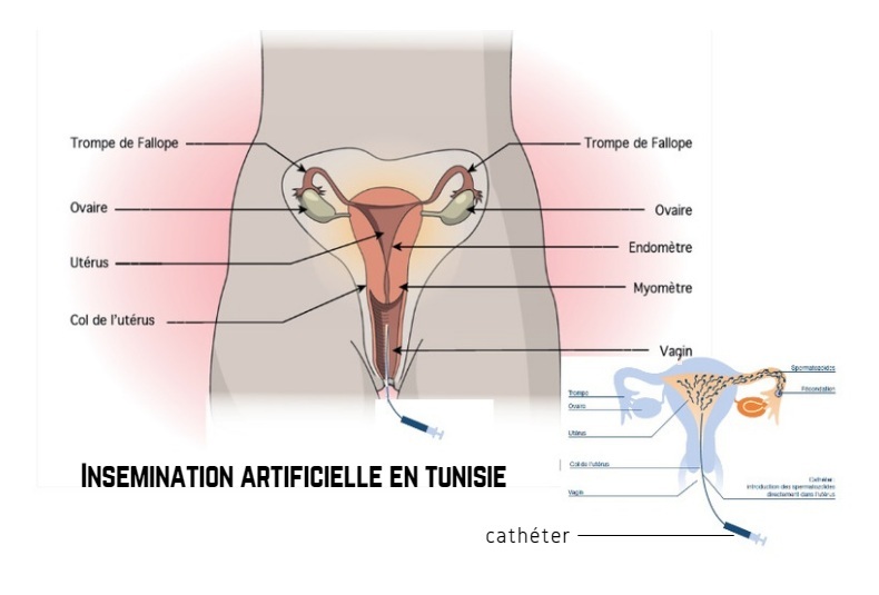 insemination artificielle Tunisie