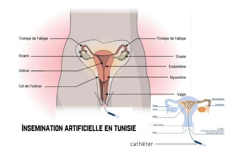 künstliche Befruchtung Tunesien