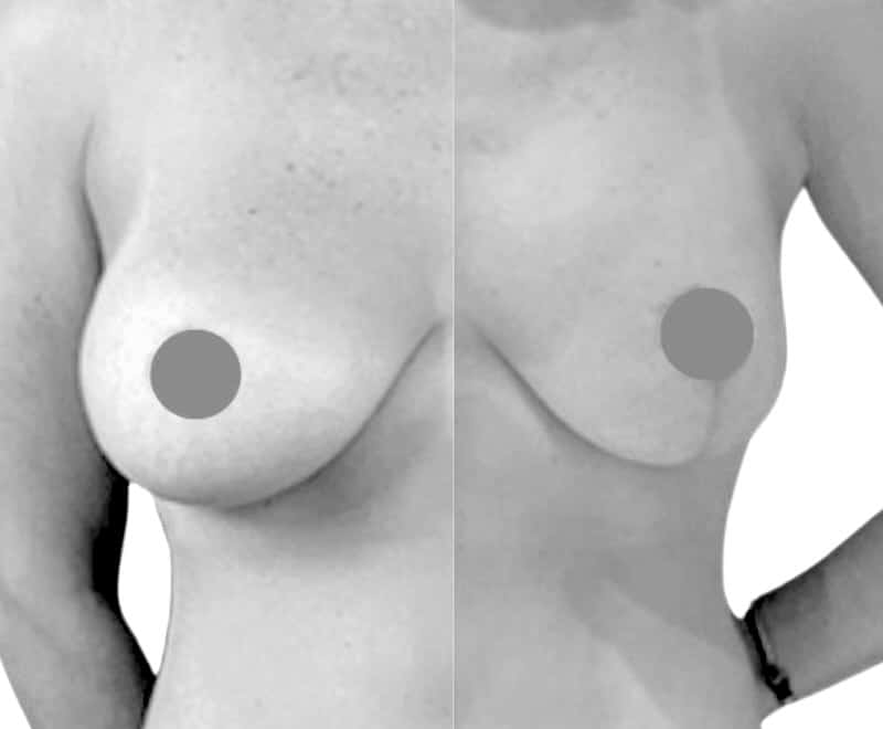 Lifting des seins en tunisie avant apres