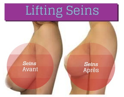 lifting seins tunisie