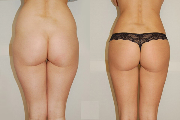 implantes de gluteoplastia tunisina