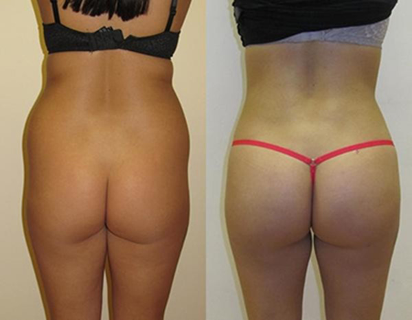 antes e depois do lipofilling das nádegas na tunísia