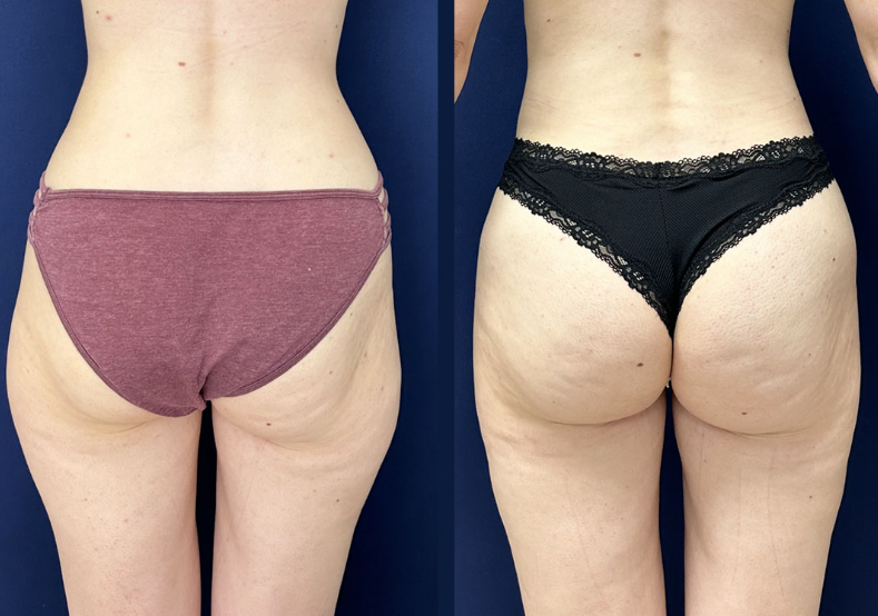 Liposuccion culotte de cheval avant apres