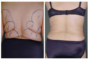 liposuction dos flans tunesien