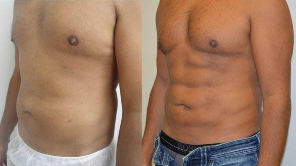 liposuccion full hd tunisie avant apres