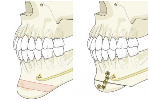 genioplastia tunisina