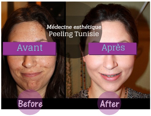 peeling facial tunísia