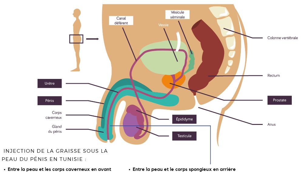  Pénoplastie en tunisie