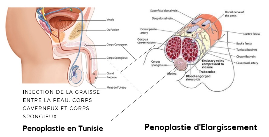  penoplastie Tunisie