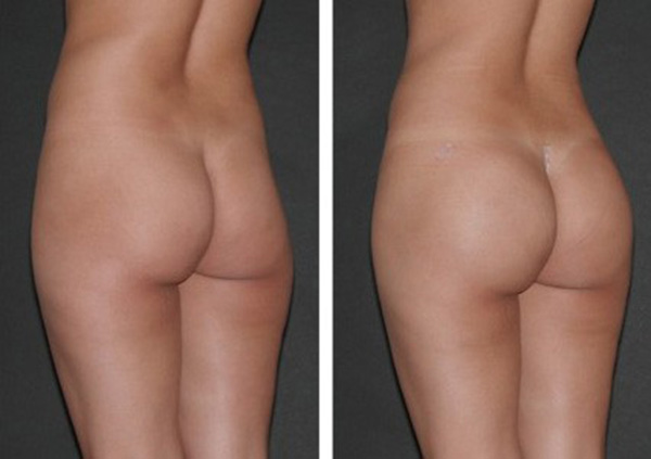 lipofilling nádegas tunisia antes e depois