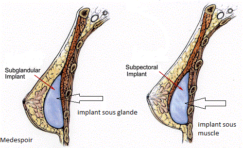 Brustprothese Tunesien