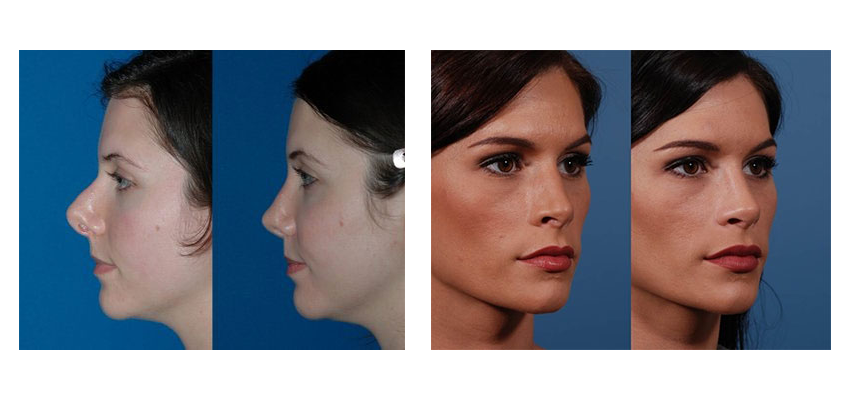 rhinoplastie tunisie