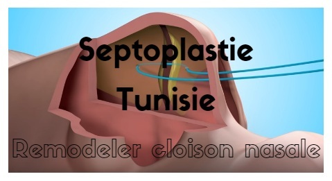 Septoplastie in Tunesien