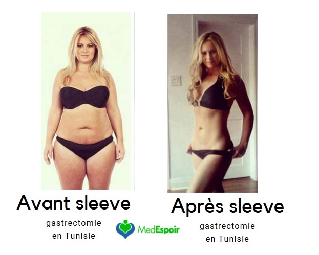 chirurgie gastrectomie sleeve  tunisie