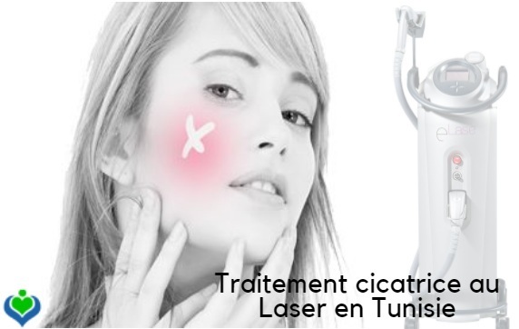 traitements cicatrices laser en tunisie