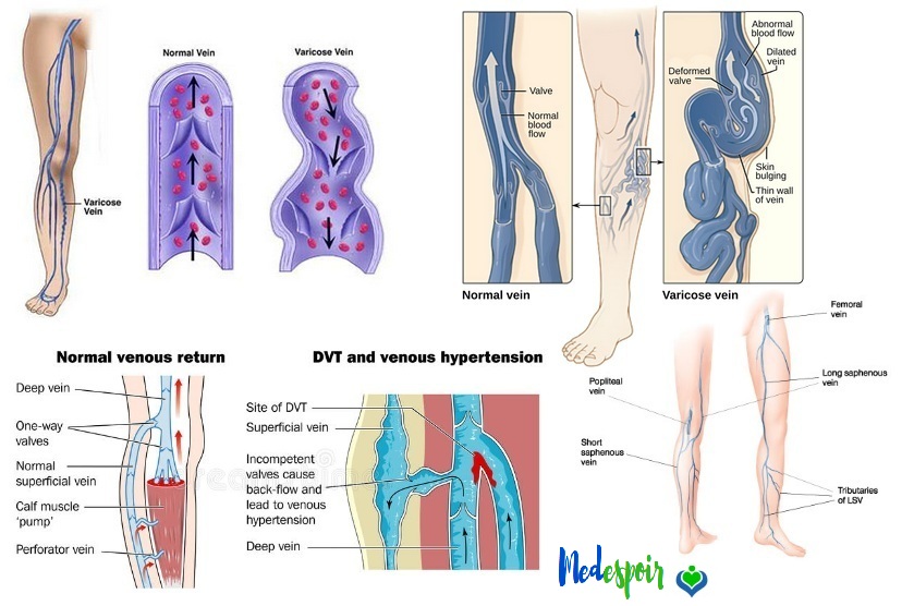 Antes e depois: couperose tratada com laser vascular